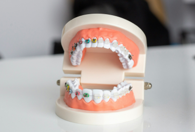 Replantarea dentara: Cand poate fi folosita pentru dintii avulsati, ce trebuie sa stim inainte de interventie