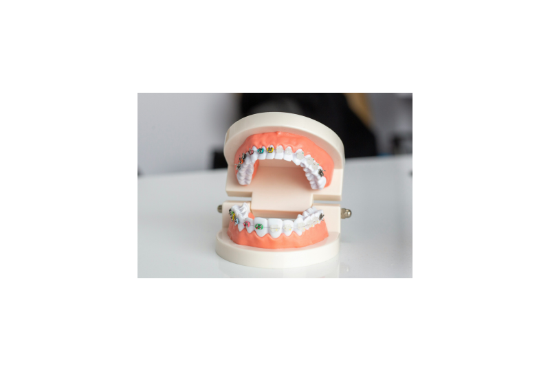 Replantarea dentara: Cand poate fi folosita pentru dintii avulsati, ce trebuie sa stim inainte de interventie