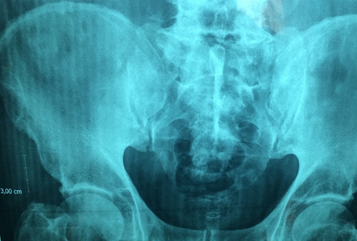 Glomerulonefrita acuta: cauze, simptome si tratament