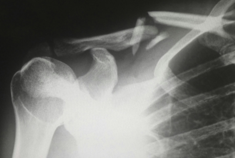Util: Tot ce trebuie sa stii despre fractura de clavicula