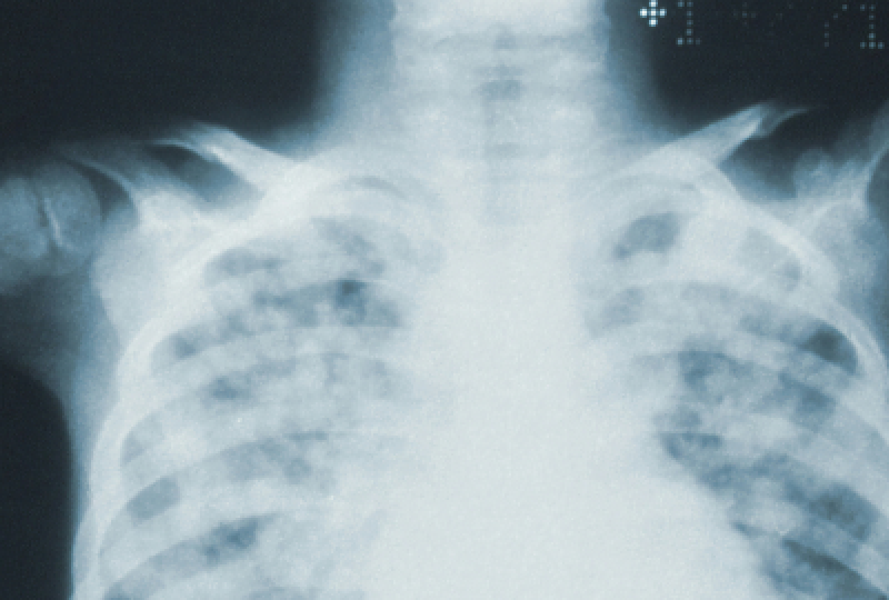 Pneumonita: tipuri, cauze, simptome si optiuni de tratament