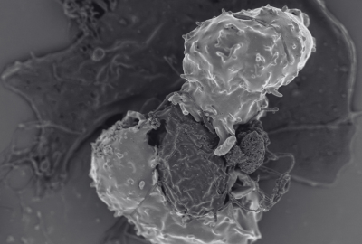 Monocite crescute: Ce sunt, importanta lor pentru organism, boli asociate cu acestea