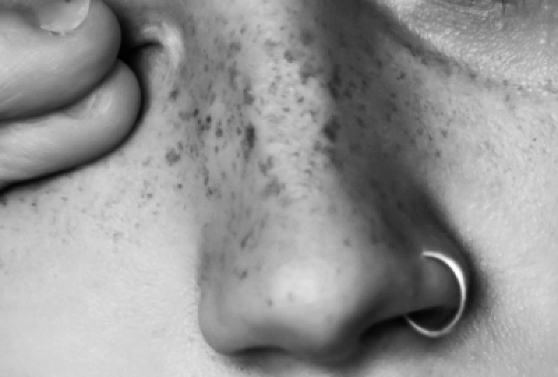 Abcesele cutanate: cauze, tratament si modalitati de preventie