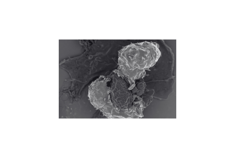 Monocite crescute: Ce sunt, importanta lor pentru organism, boli asociate cu acestea