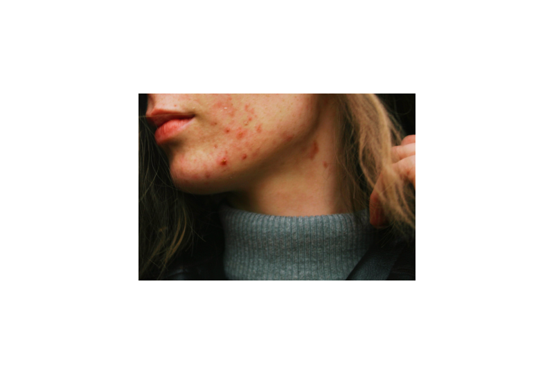 Furunculoza: cauze, simptome, optiuni de tratament si preventie