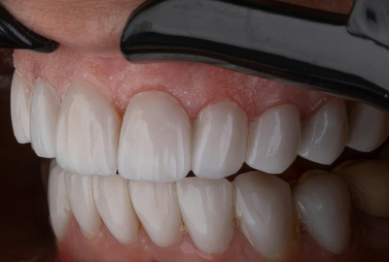 Dantura din zirconiu: Cand se recomanda folosirea ei, ce trebuie sa stim inainte de implant