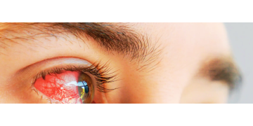 Infectia stafilococica oculara: Cum apare boala, metode de preventie si tratament