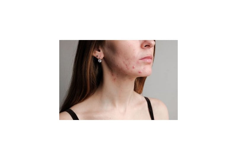 Acneea: cauze, tipuri, tratament, preventie