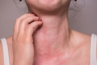 Alergia la Soare, eruptia polimorfa la lumina: cauze si tratament