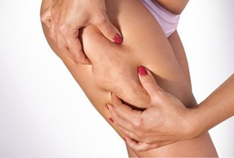 Celulita: de ce apare, tipuri si metode de tratament