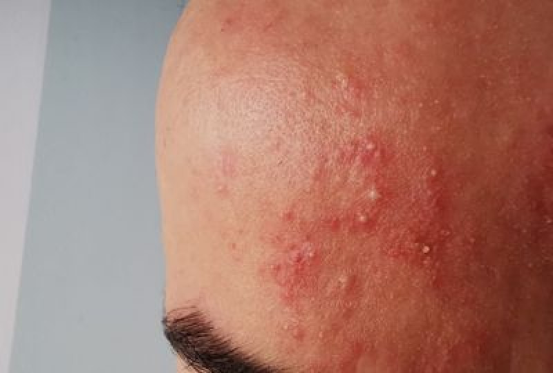 Cuperoza: cauze, tratament, preventie