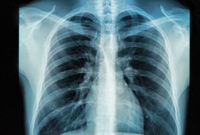 Dextrocardia: Ce inseamna, cum se poate trata