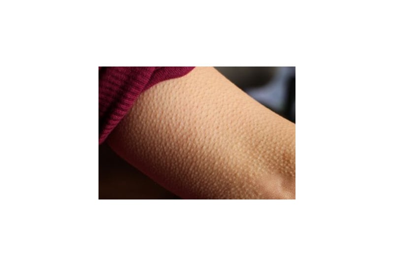 Keratoza pilara: cauze, simptome, remedii, secrete ale pielii