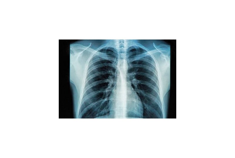 Dextrocardia: Ce inseamna, cum se poate trata