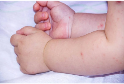 Eczema numulara: principalele simptome, cauze, tratament