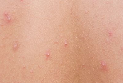 Furuncul: cauze, diagnostic, tratament