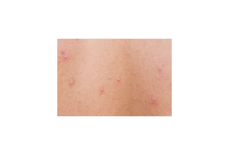 Furuncul: cauze, diagnostic, tratament