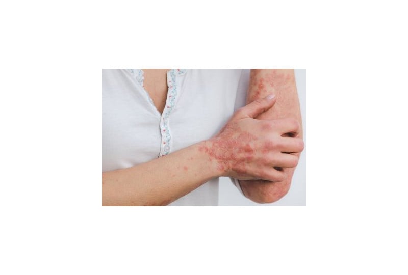 Psoriazis: cum arata, de ce apare si cum se trateaza
