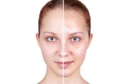 Remedii naturale contra acneei. Cum le alegi