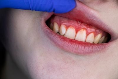 Sangerari gingivale la periaj: cauze si tratament