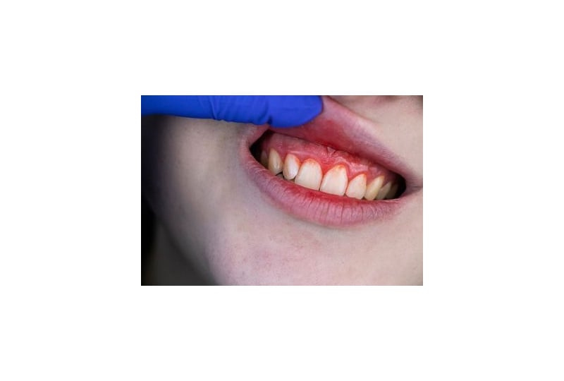 Sangerari gingivale la periaj: cauze si tratament