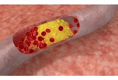Hipercolesterolemia: Cum apare, simptome, metode de preventie si tratament
