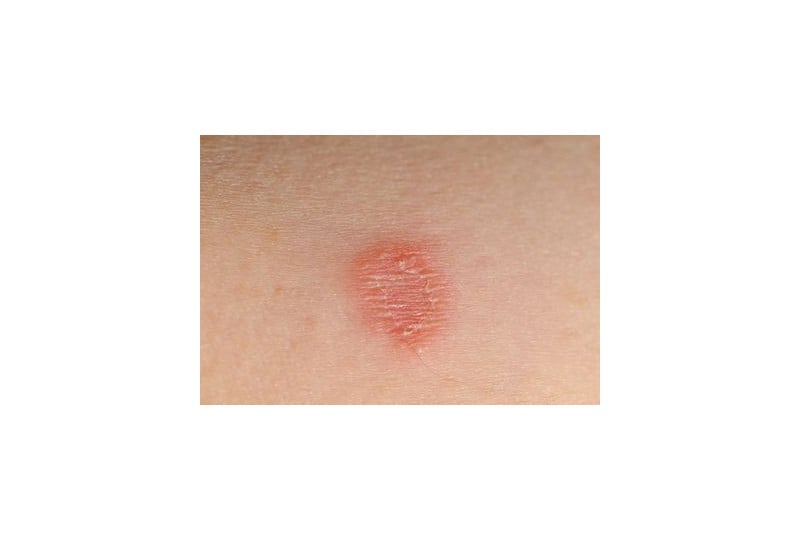 Tinea versicolor - ce este, cauze, simptome, tratament