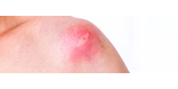 Muscaturi de paianjeni, purice, tantar, intepatura de viespe: Ghid complet despre identificare, prim ajutor, preventie muscaturi de insecte