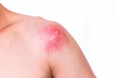 Totul despre intepaturile de insecte: Simptome, tratament, preventie