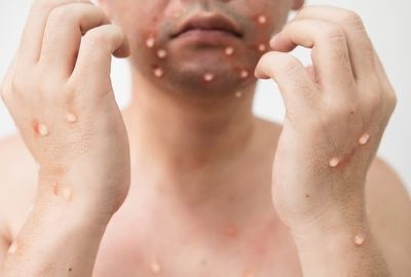 Variola maimutei: Simptome, transmitere, preventie si tratament