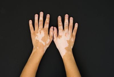Vitiligo: Ce este, cum se manifesta, solutii de tratament