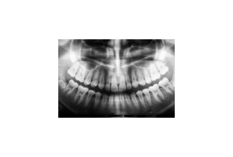 Fracturile dentare: De ce apar, simptome si tipuri de tratament