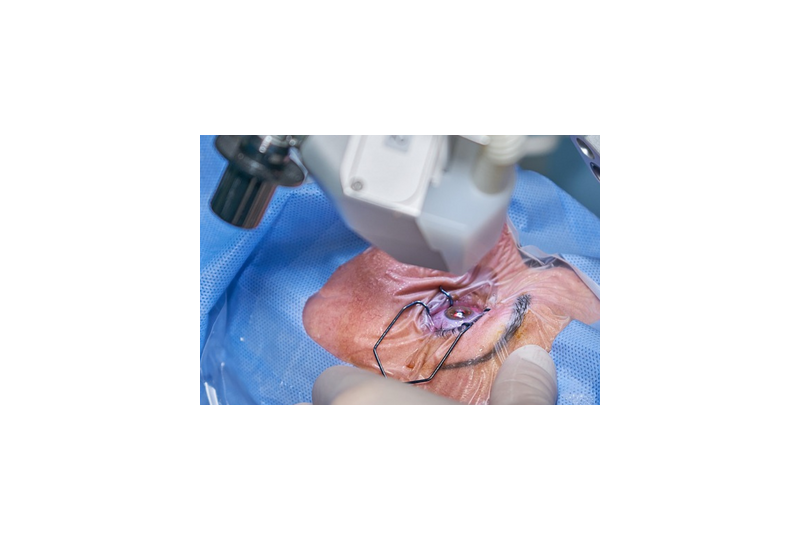 Transplant de cornee: Cand se recomanda si ce presupune inlocuirea corneei