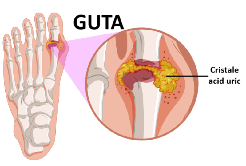 Alimente permise in guta: recomandari, contraindicatii, cum poti gestiona afectiunea