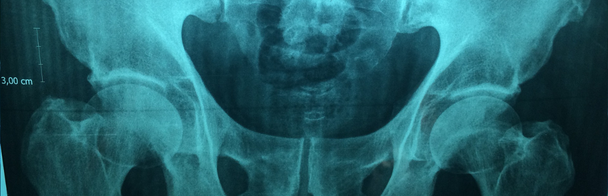 Glomerulonefrita acuta: cauze, simptome si tratament
