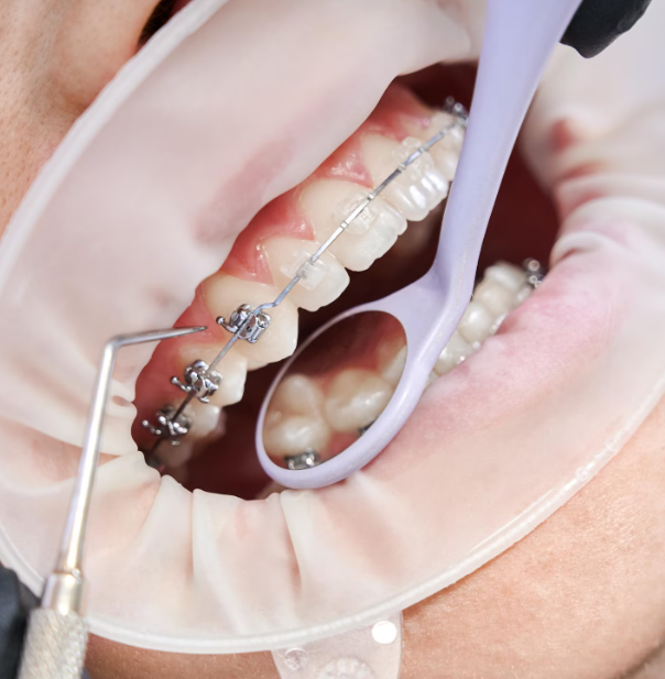 Aparat dentar