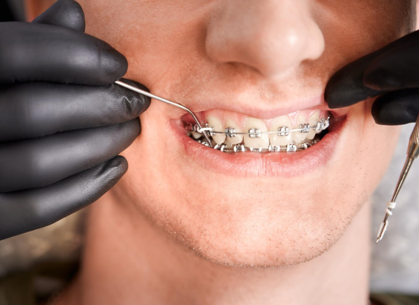 Aparat dentar