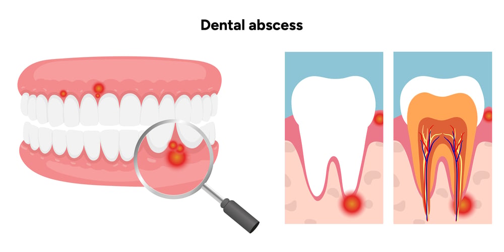 Cum arata un abces dentar