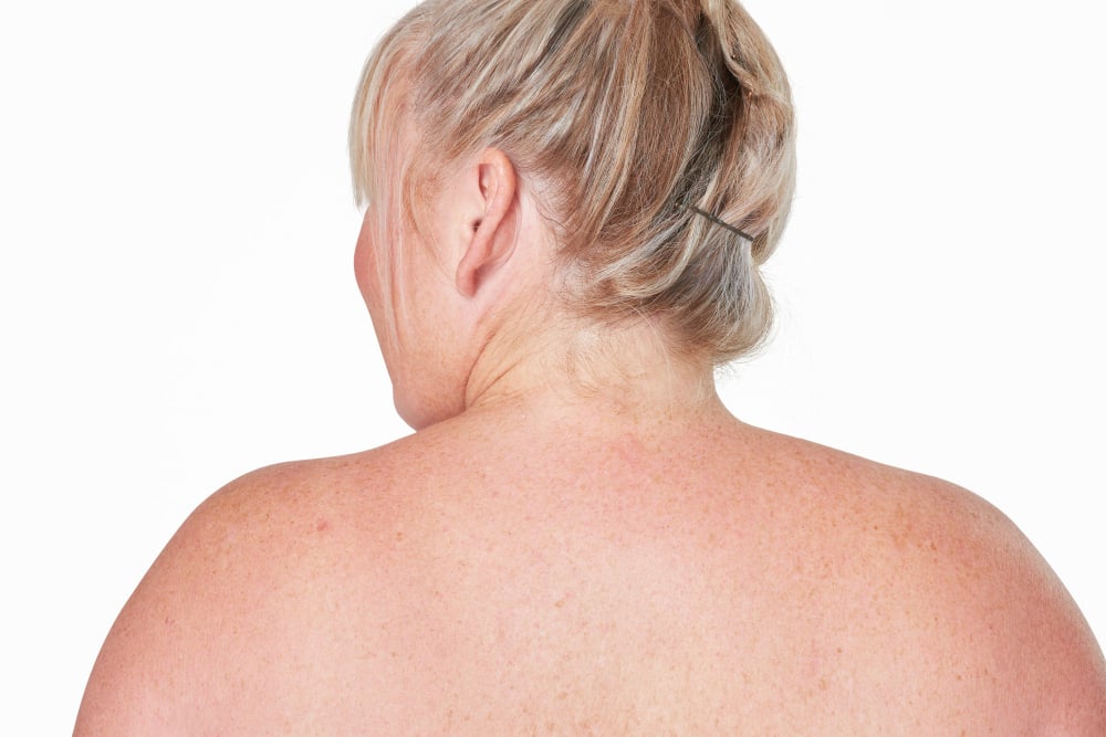piele_cu_acnee_pe_spate piele_cu_acnee_pe_spate