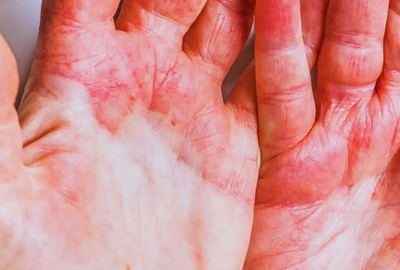 dermatita-atopica-poze