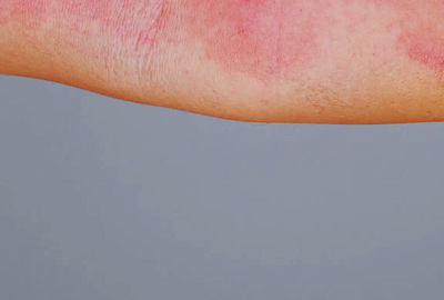 eczema-la-bebelusi-imagini