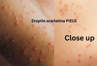 eruptie_scarlatina_piele
