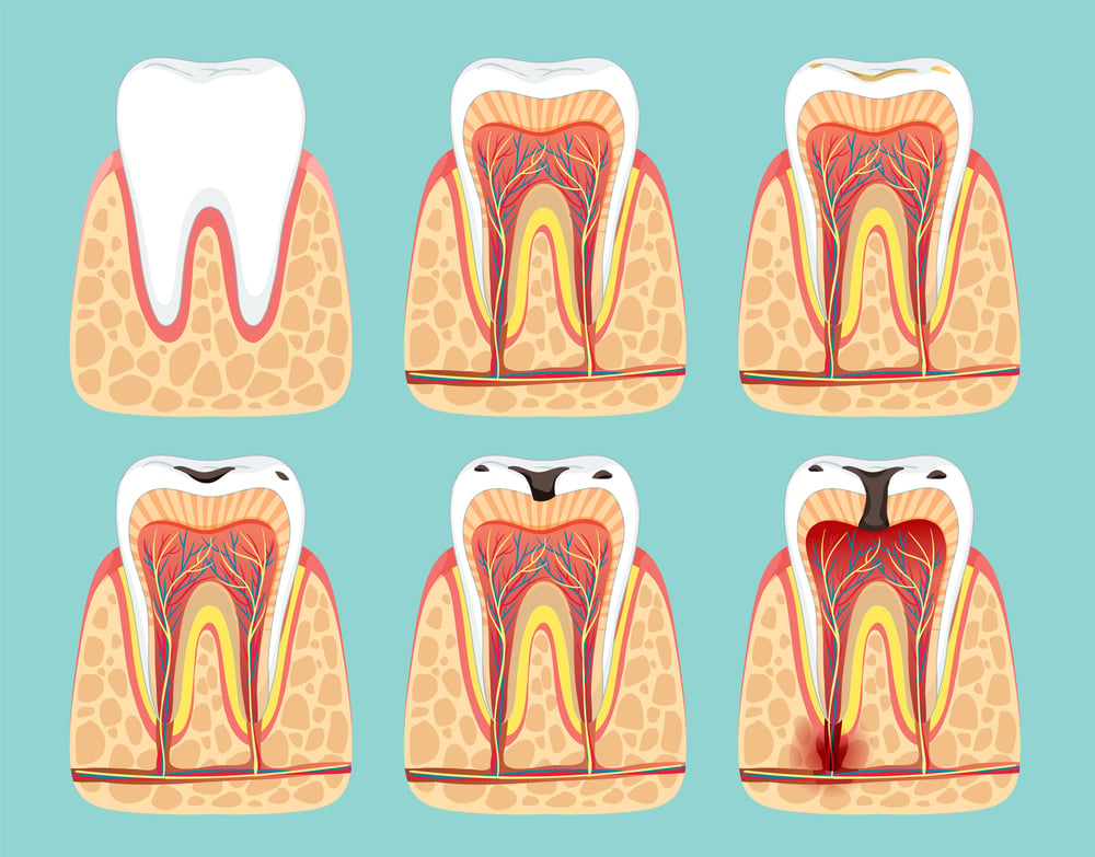 Carii care declanseaza un abces dentar