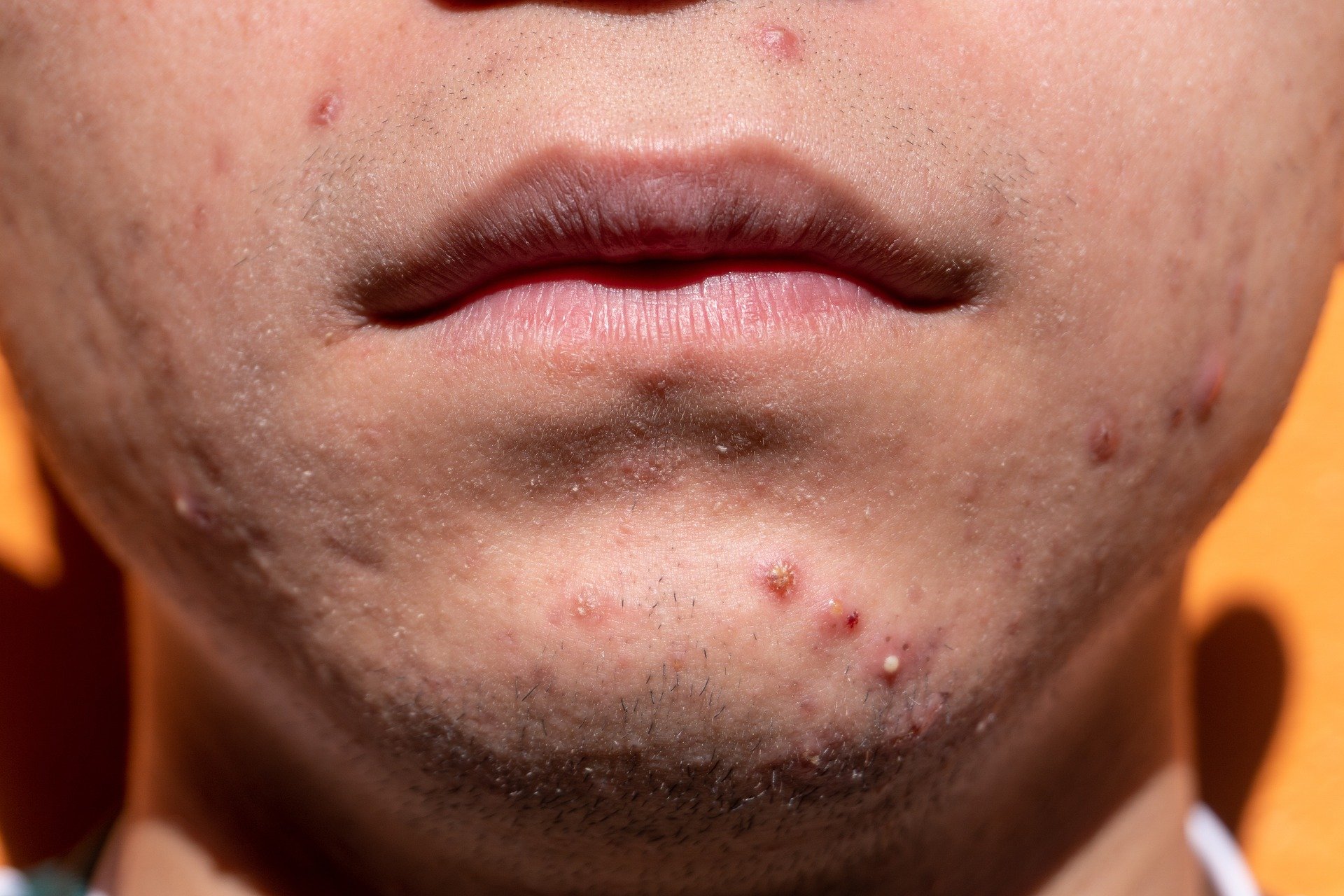 dermatita-alergica-cronica