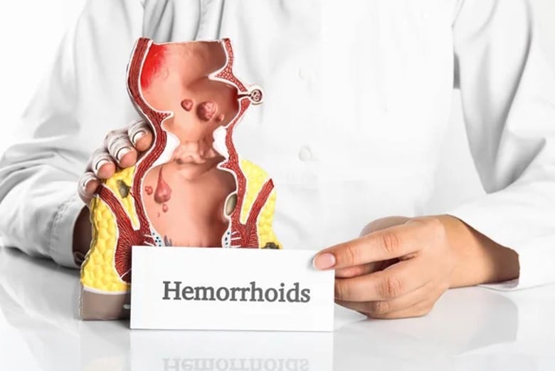 Tipuri hemoroizi