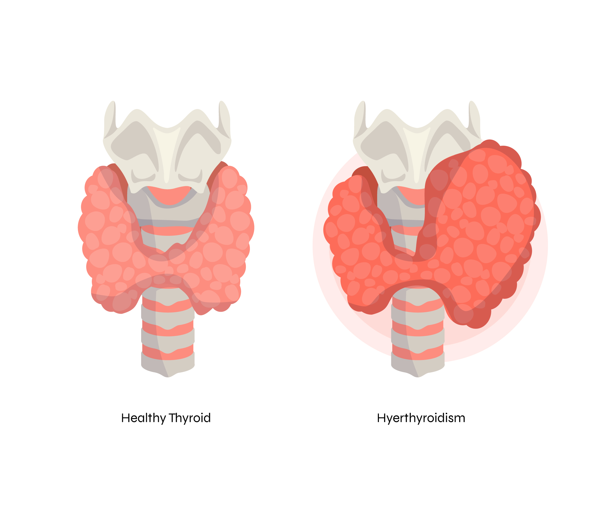 Hipertiroidism