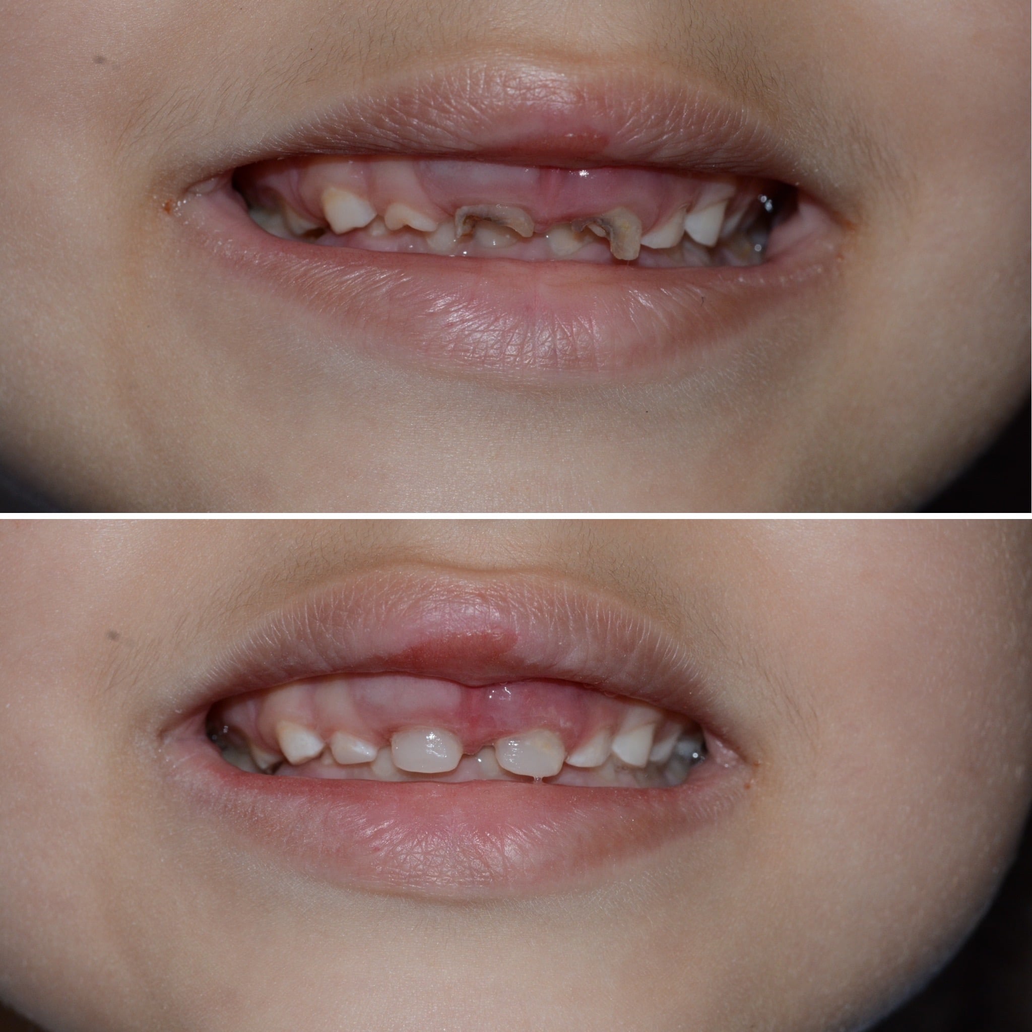 urme bruxism