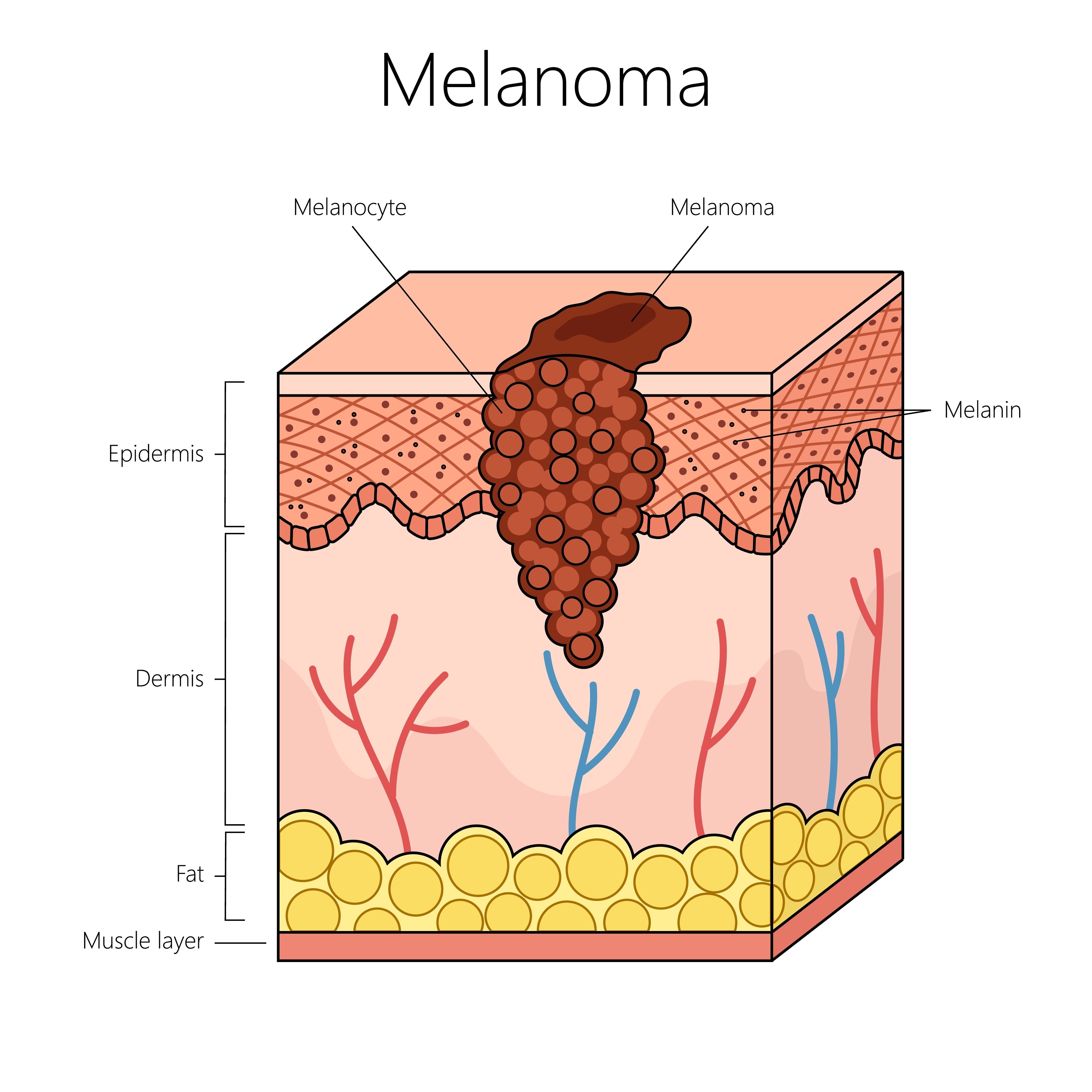 melanom_schema