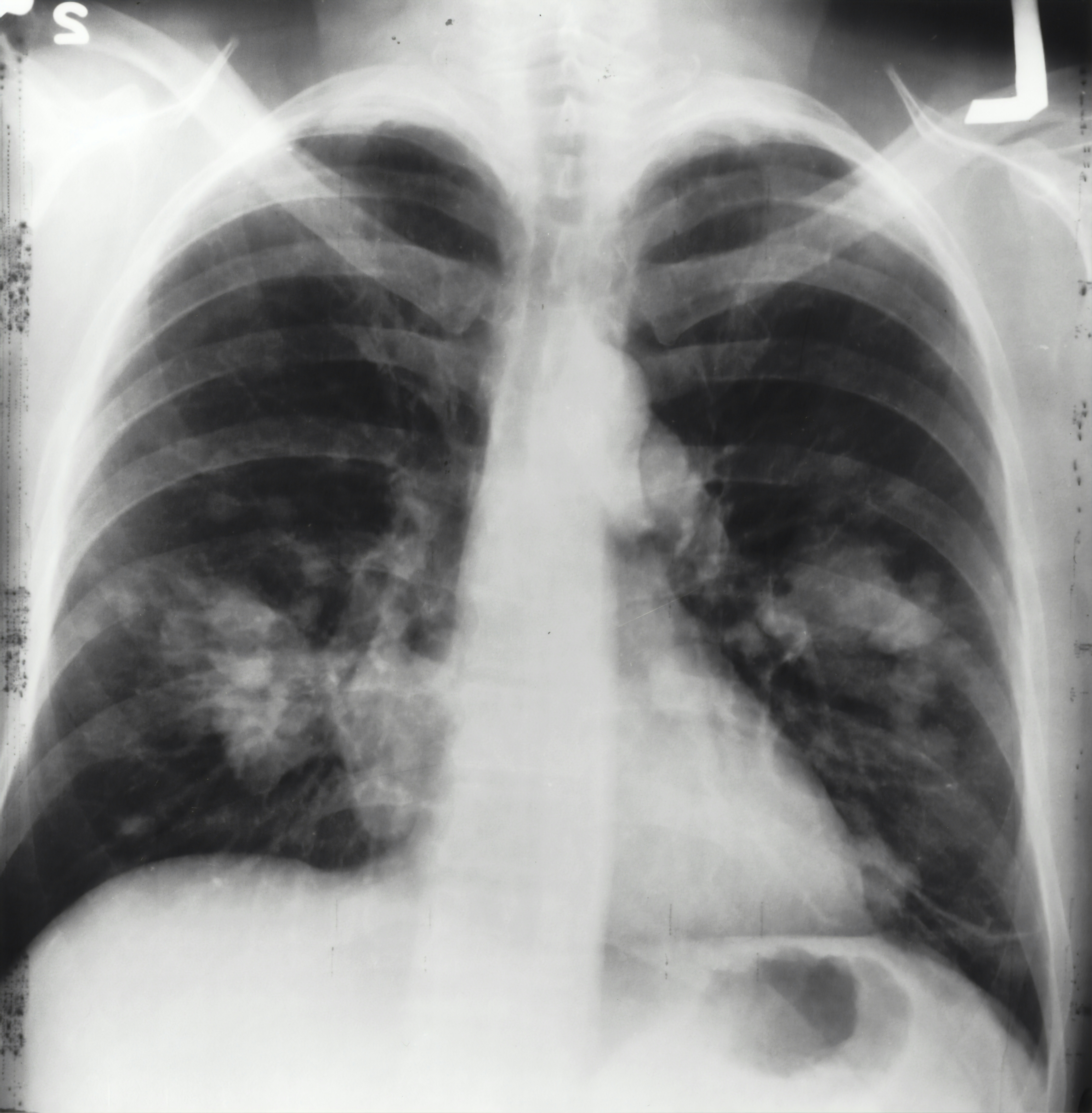 dureri_pulmonare