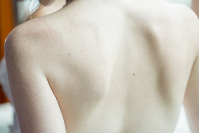 piele_spate